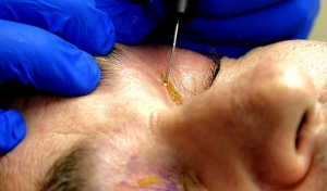 Xanthelasma  - Study
