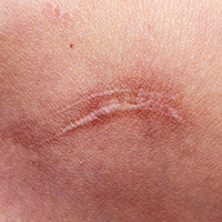 Cicatrici post parto e altre trattamento plasmage